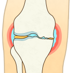 変形性膝関節症